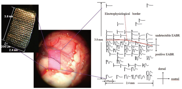Electrophysiological mapping system for auditory brainstem implant