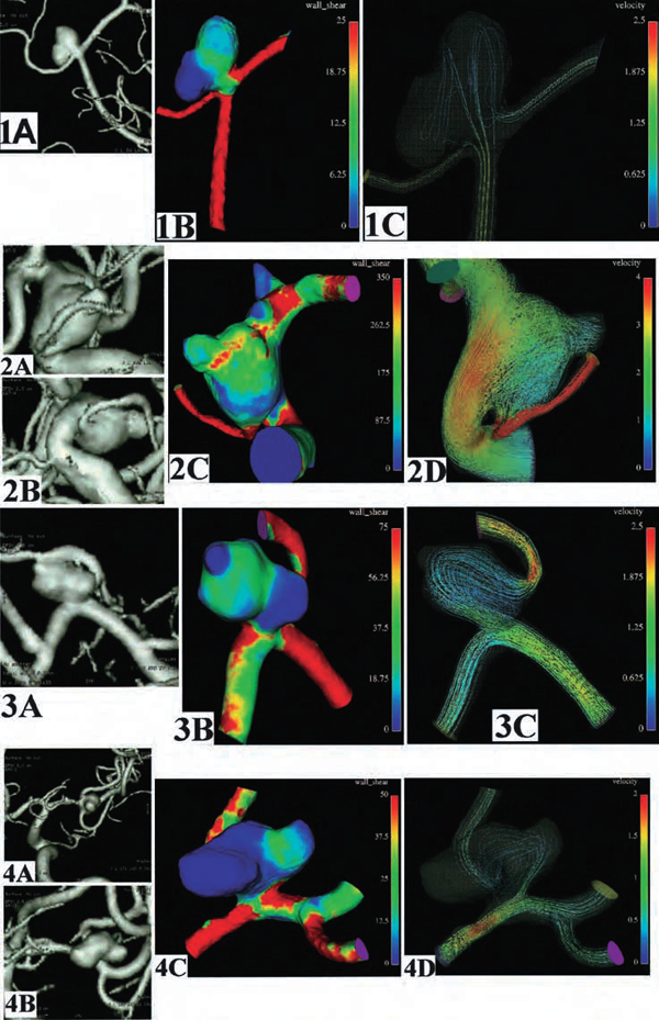 Patient data specific CFD analysis of brain aneurysm. This type of aneurysm had strong relationship between maximum wall shear stress and growth and rupture.