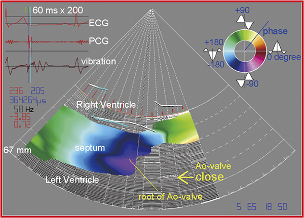 Imaging of propagation of spontaneous vibration in the heart wall