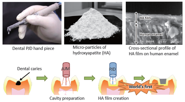 New dental treatment utilizing powder jet deposition of hydroxyapatite