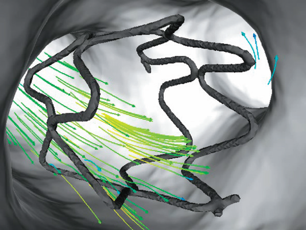 Blood flow in stent on cerebral artery with aneurysm