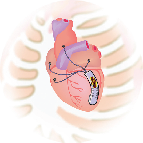 Schematic illustration of the artificial myocardium