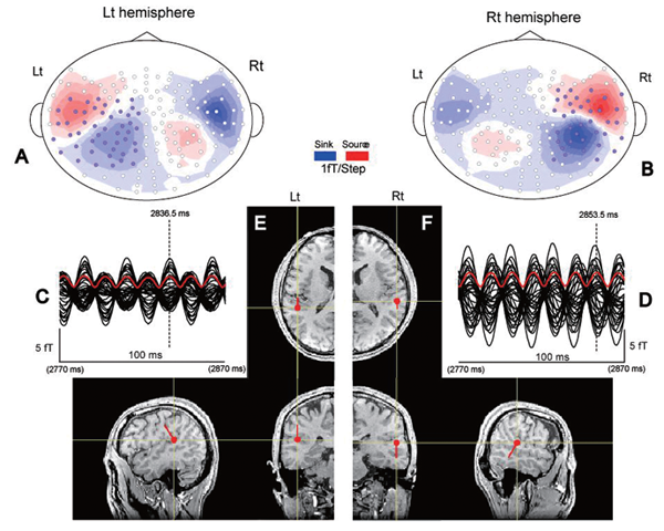 脳磁図を用いた聴性定常反応に関する研究